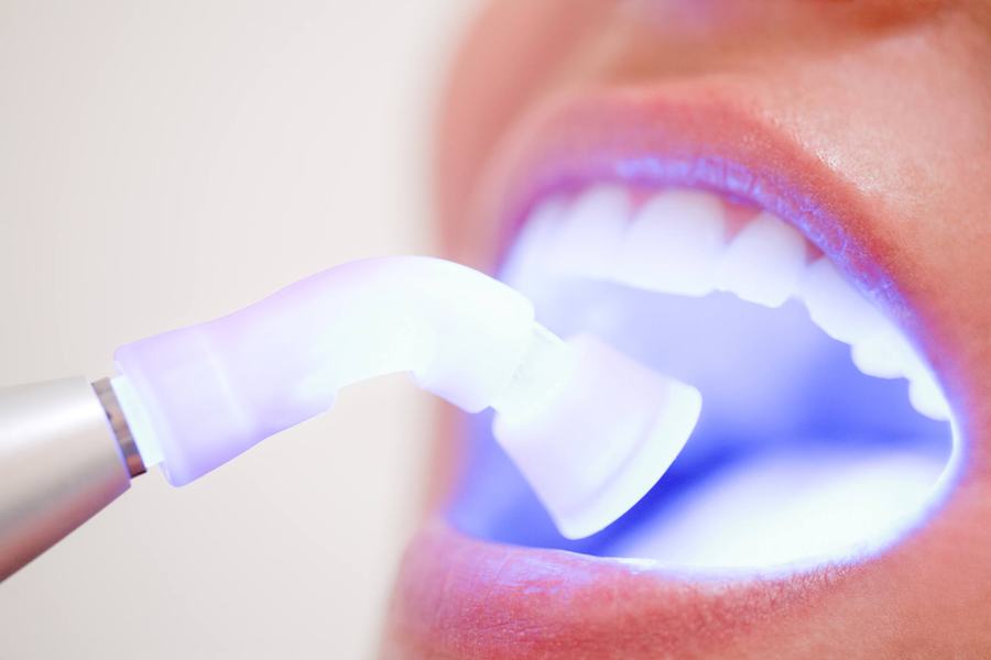 Procedimento de clareamento dentário a laser