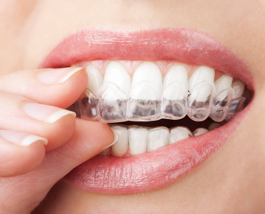 Moldeira personalizada para clareamento dentário