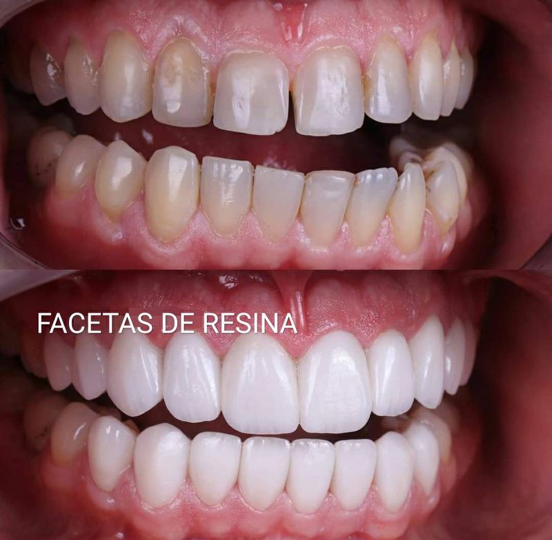 Caso de facetas em resina realizado na Clínica Odonto QualityBH
