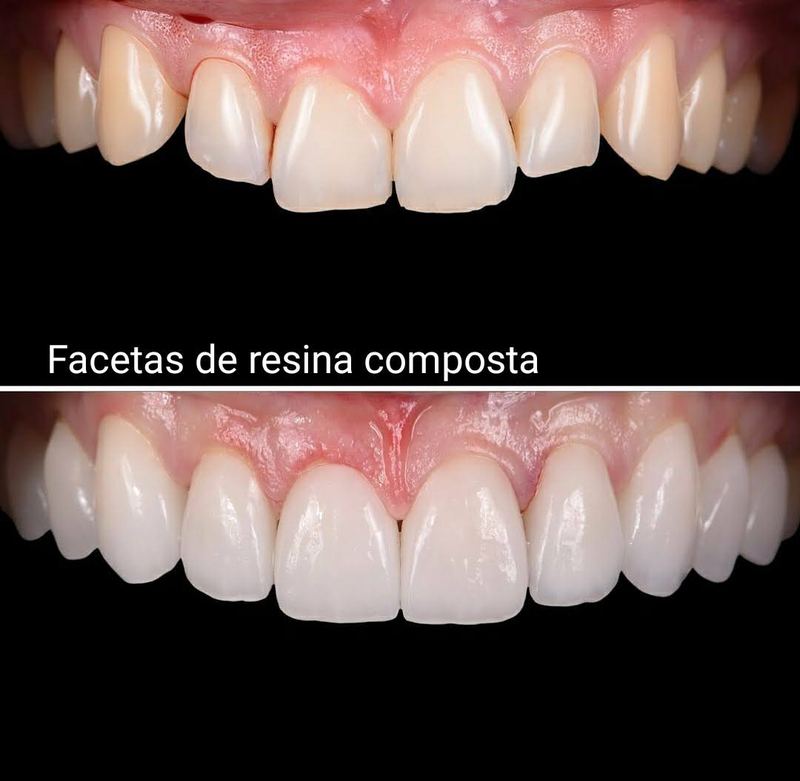 Caso de facetas em resina realizado na Clínica Odonto QualityBH