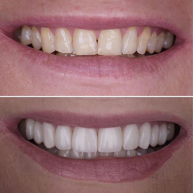 Caso de facetas em resina realizado na Clínica Odonto QualityBH