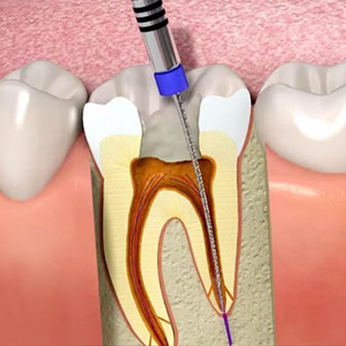 Ilustração do tratamento de canal odontológico